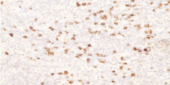 B LYMPHOCYTES IHC POSITIVE FOR CD 20