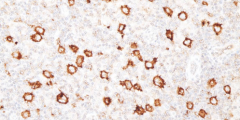 R-S GIANT CELLS OR HODGKIN’S CELLS FOR CD30